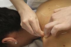 acupuntura