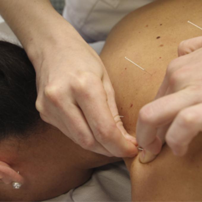 acupuntura